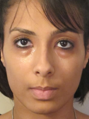 before photo of a patient treated with Restylane under the eyes