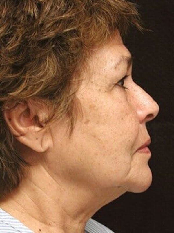 Facelift Before & After Gallery - Patient 25139311 - Image 1