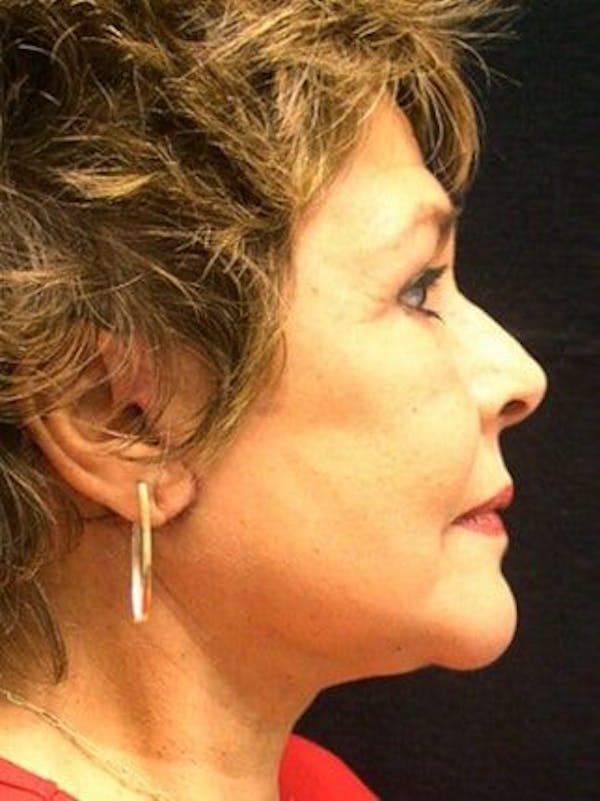 Facelift Before & After Gallery - Patient 25139311 - Image 2