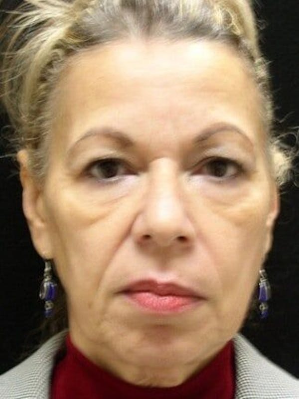 Facelift Before & After Gallery - Patient 25139328 - Image 1
