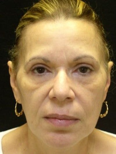 Facelift Before & After Gallery - Patient 25139328 - Image 2