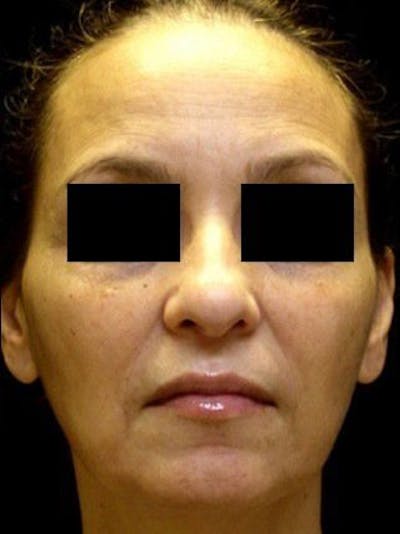 Facelift Before & After Gallery - Patient 25139333 - Image 1