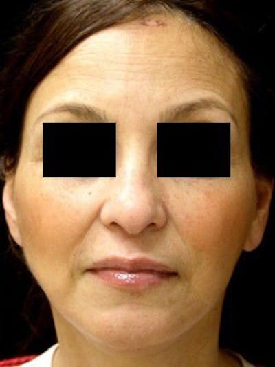 Facelift Before & After Gallery - Patient 25139333 - Image 2