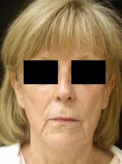 Facelift Before & After Gallery - Patient 25139345 - Image 1