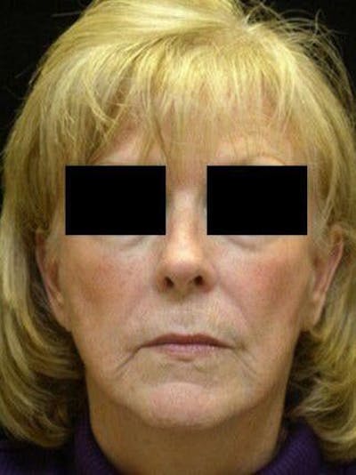 Facelift Before & After Gallery - Patient 25139345 - Image 2