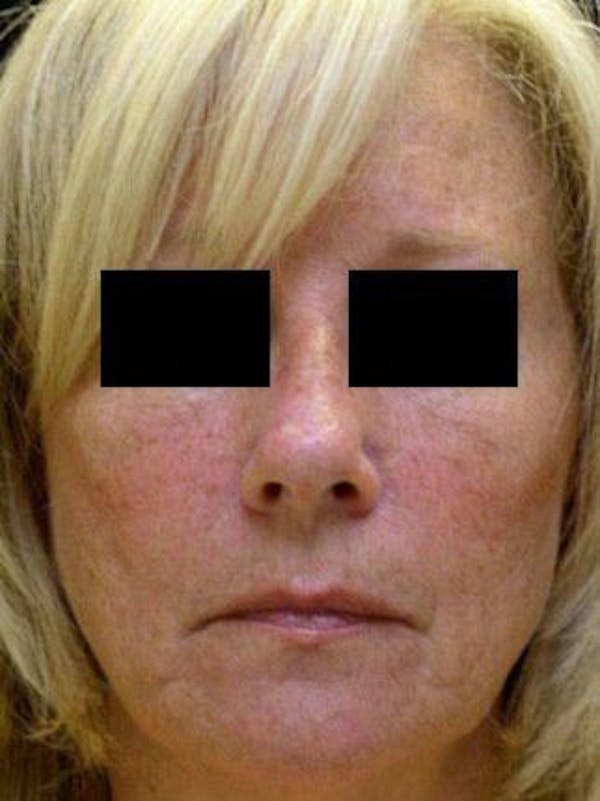 Facelift Before & After Gallery - Patient 25139346 - Image 1