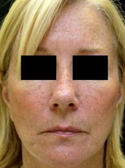 Before & After Deep Plane Facelift in Westchester, New York - 03