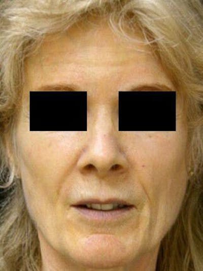 Facelift Before & After Gallery - Patient 25139371 - Image 1