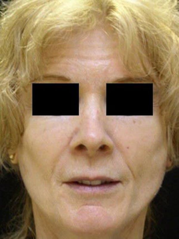 Facelift Before & After Gallery - Patient 25139371 - Image 2