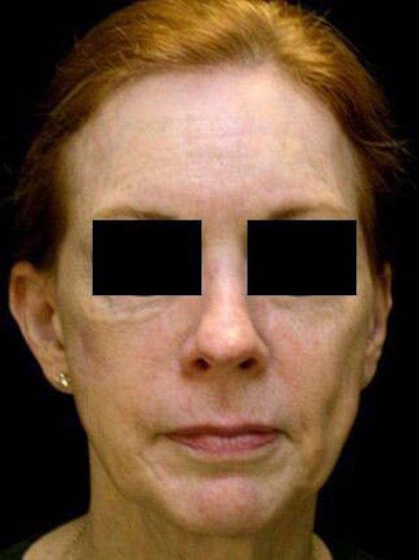 Facelift Before & After Gallery - Patient 25139372 - Image 1