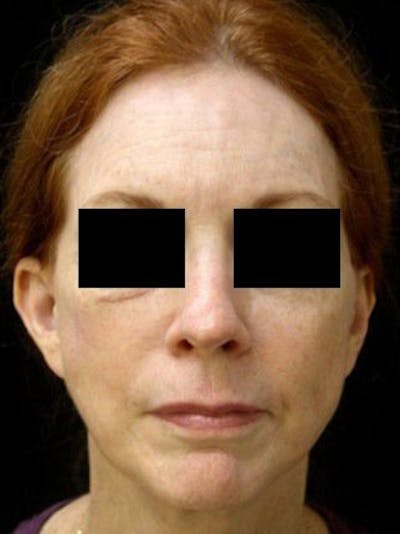 Facelift Before & After Gallery - Patient 25139372 - Image 2
