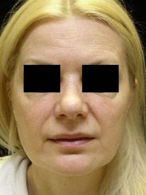 Facelift Before & After Gallery - Patient 25139377 - Image 1