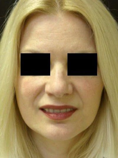Facelift Before & After Gallery - Patient 25139377 - Image 2