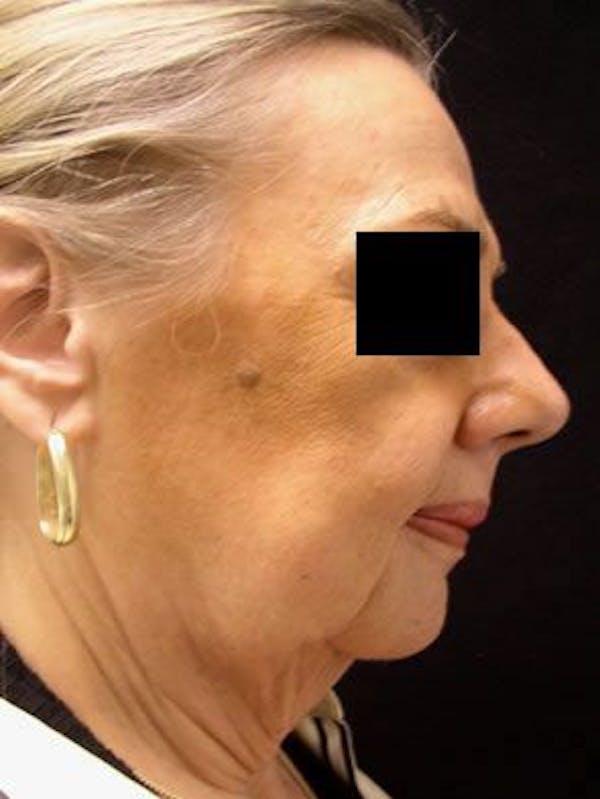 Facelift Before & After Gallery - Patient 25139378 - Image 1