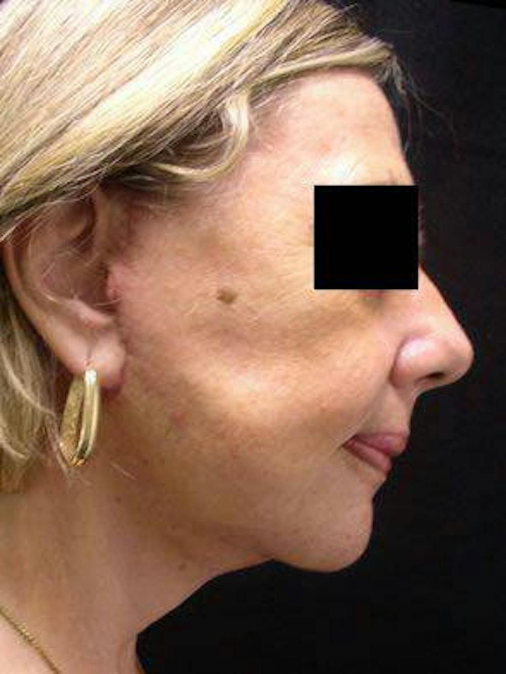 Facelift Before & After Gallery - Patient 25139378 - Image 2