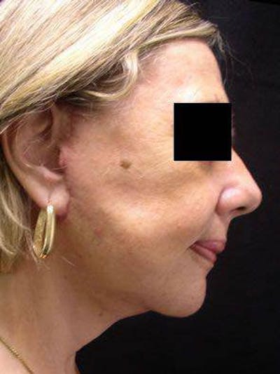 Facelift Before & After Gallery - Patient 25139378 - Image 2