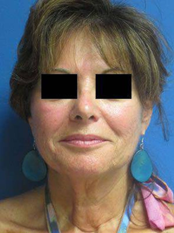 Necklift Before & After Gallery - Patient 121745308 - Image 1