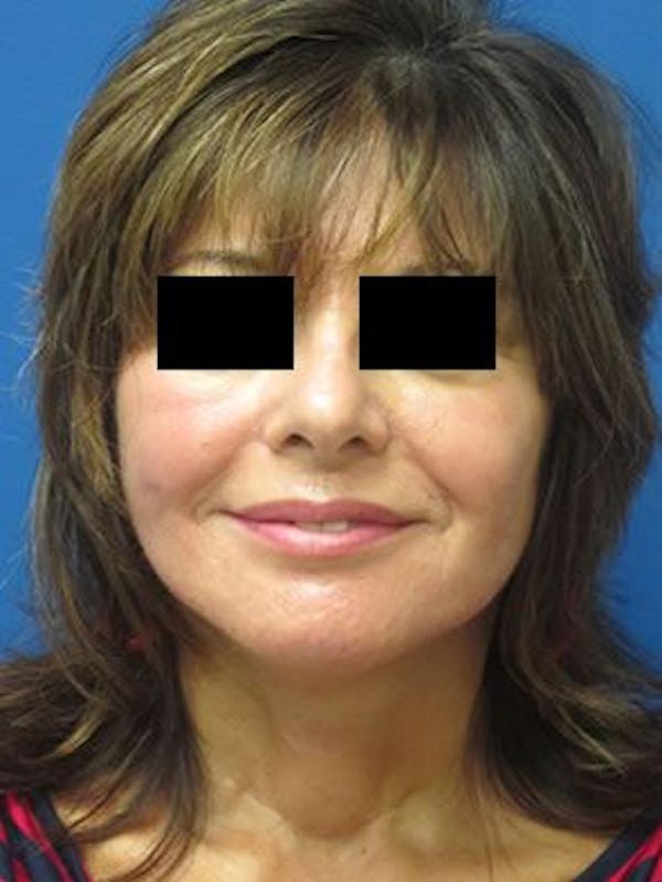 Facelift Before & After Gallery - Patient 25139381 - Image 2