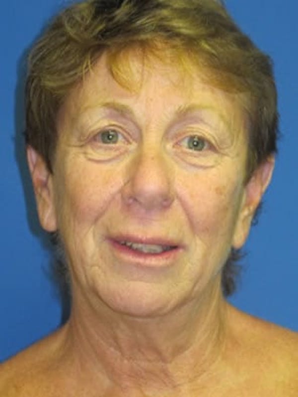 Facelift Before & After Gallery - Patient 25139383 - Image 1