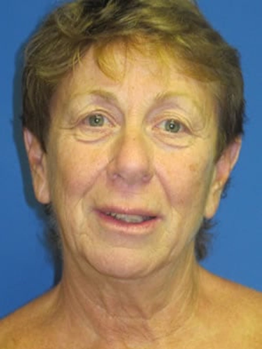 Necklift Before & After Gallery - Patient 121745307 - Image 1