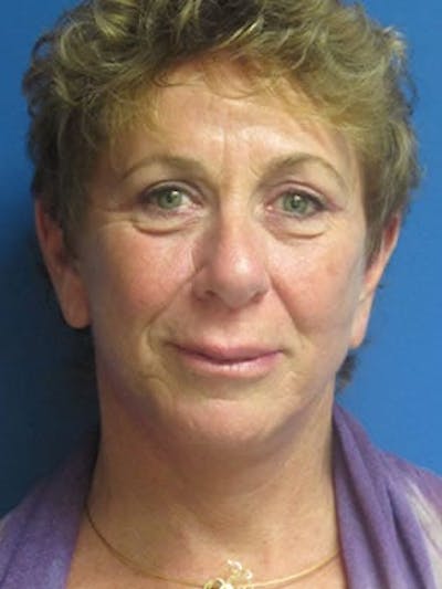 Facelift Before & After Gallery - Patient 25139383 - Image 2