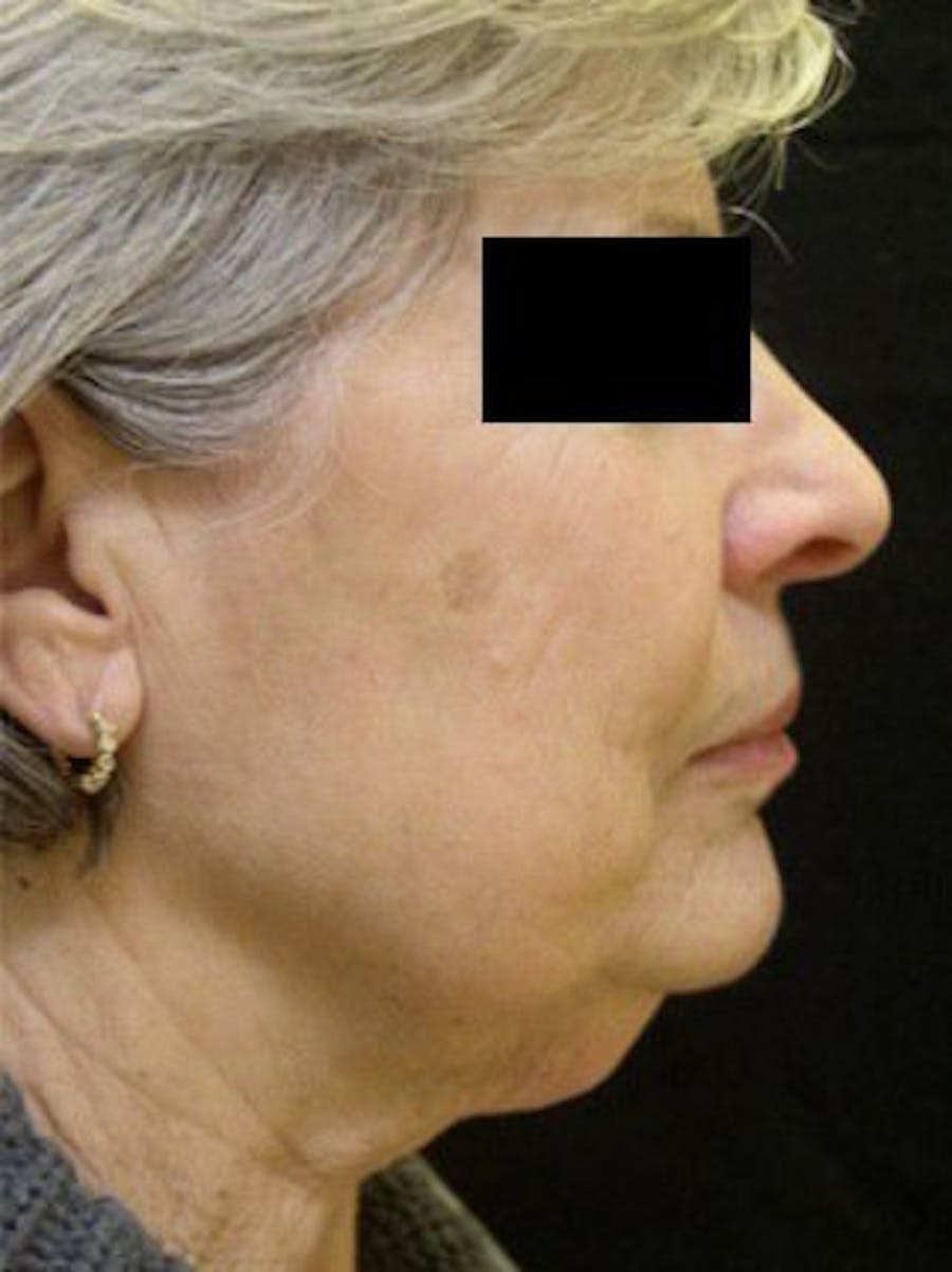Necklift Before & After Gallery - Patient 121745306 - Image 1