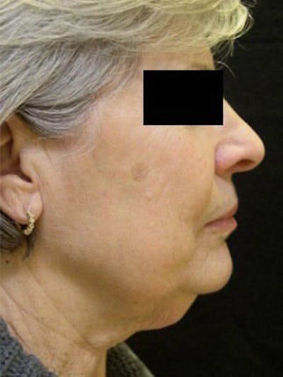 Necklift Before & After Gallery - Patient 121745306 - Image 1