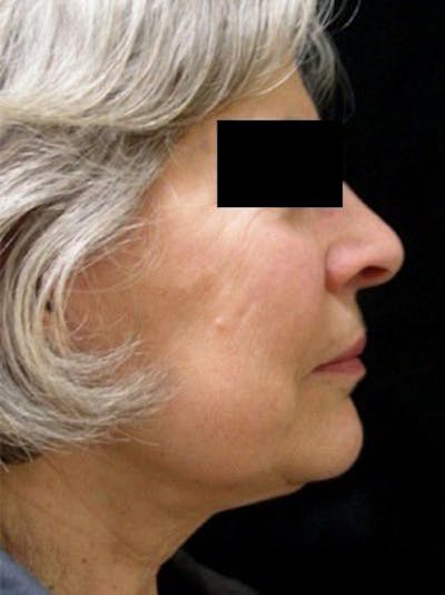 Necklift Before & After Gallery - Patient 121745306 - Image 2