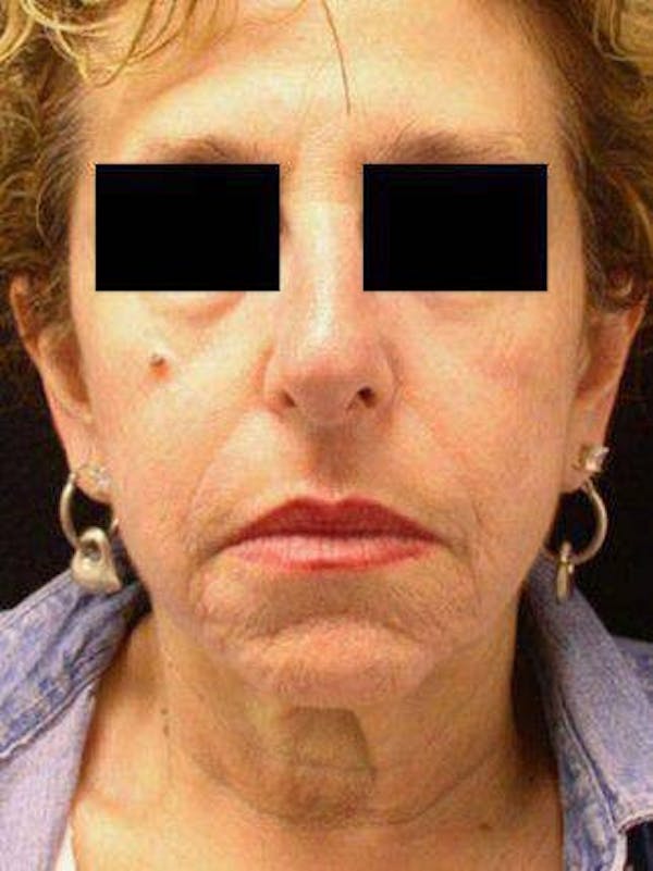 Necklift Before & After Gallery - Patient 121745305 - Image 1