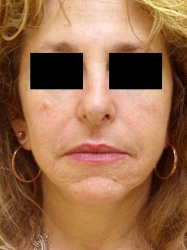 Necklift Before & After Gallery - Patient 121745305 - Image 2
