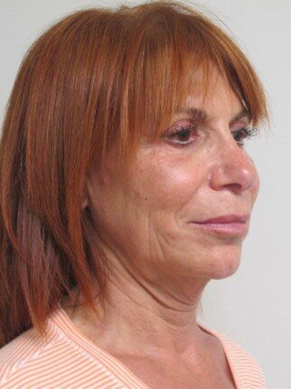 Facelift Before & After Gallery - Patient 121745296 - Image 3