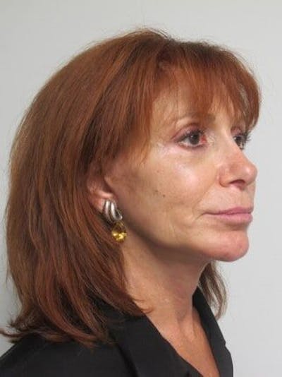 Before & After Facelift in Westchester, New York