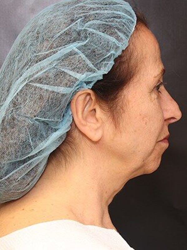 Facelift Before & After Gallery - Patient 25139388 - Image 1