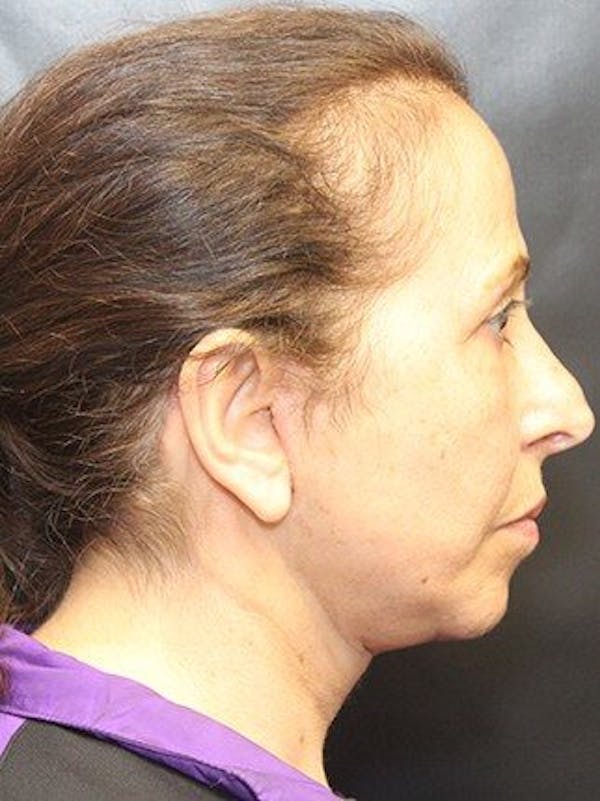 Facelift Before & After Gallery - Patient 25139388 - Image 2