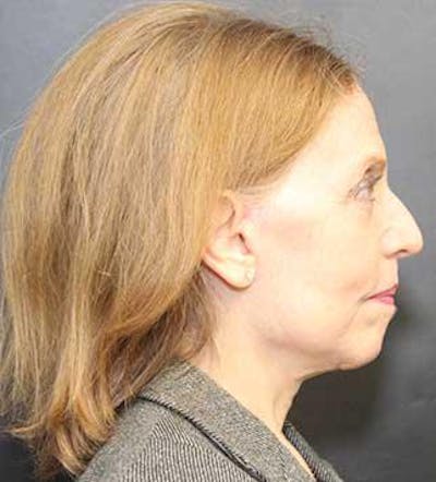 Facelift Before & After Gallery - Patient 25139399 - Image 2