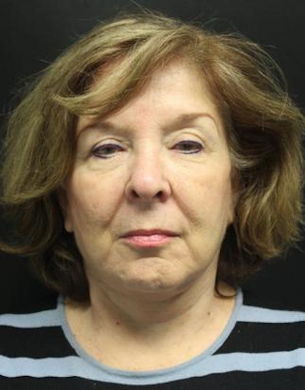 Necklift Before & After Gallery - Patient 121745293 - Image 2