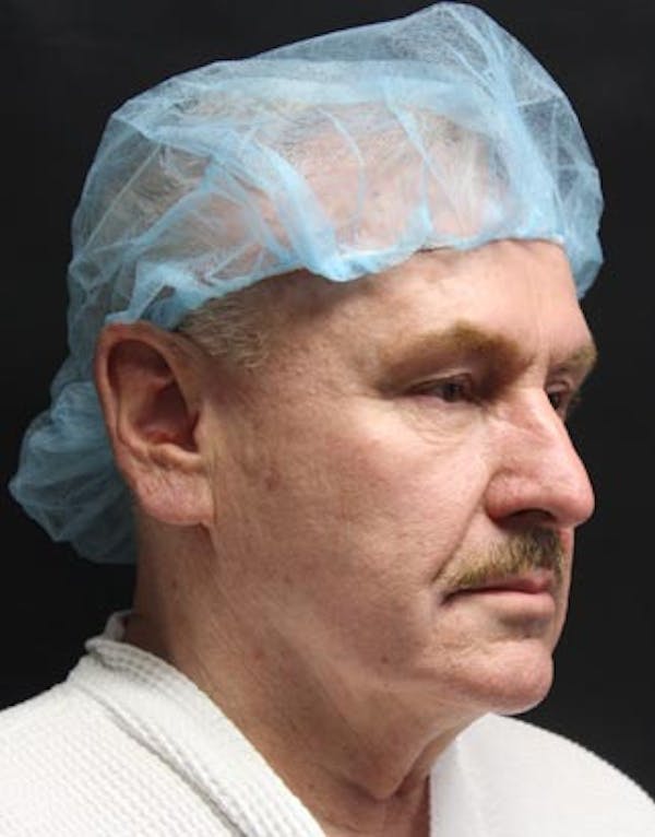 Facelift Before & After Gallery - Patient 25139402 - Image 1