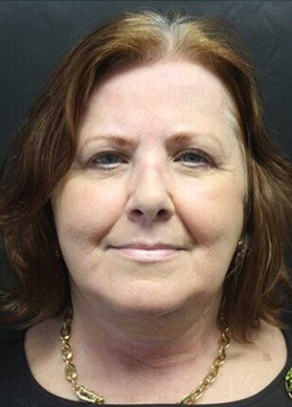 Facelift Before & After Gallery - Patient 25139428 - Image 2