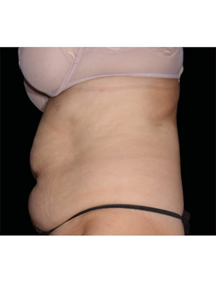 Emsculpt Neo Before & After Gallery - Patient 25139429 - Image 1