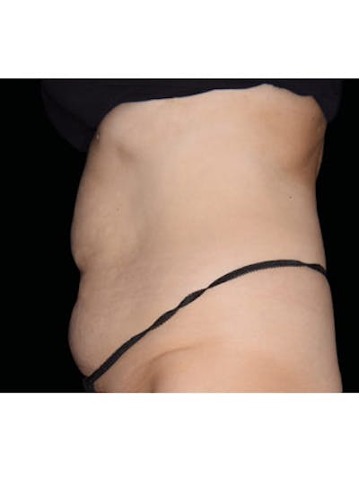 Emsculpt Neo Before & After Gallery - Patient 25139429 - Image 2