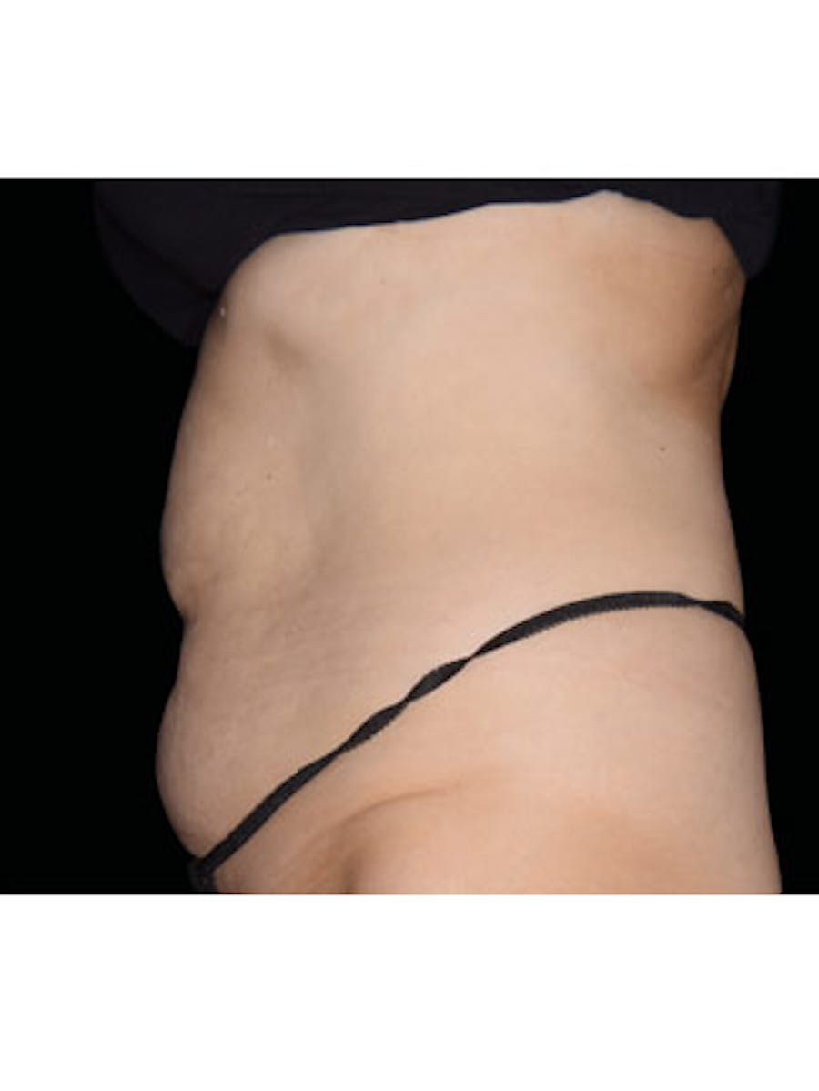 Emsculpt Neo Before & After Gallery - Patient 25139429 - Image 2