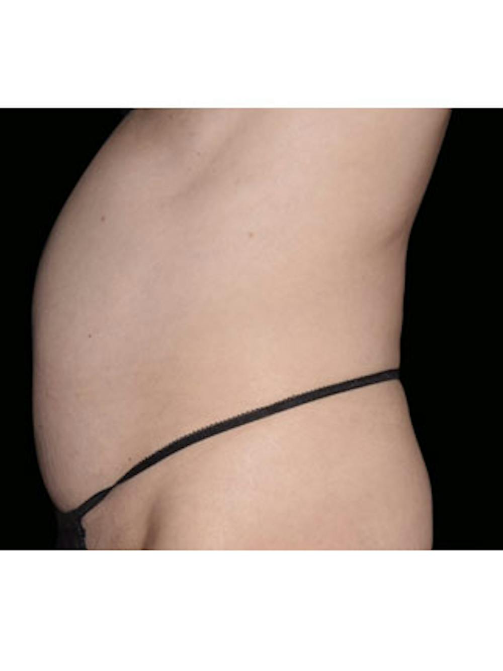 Emsculpt Neo Before & After Gallery - Patient 25139433 - Image 1