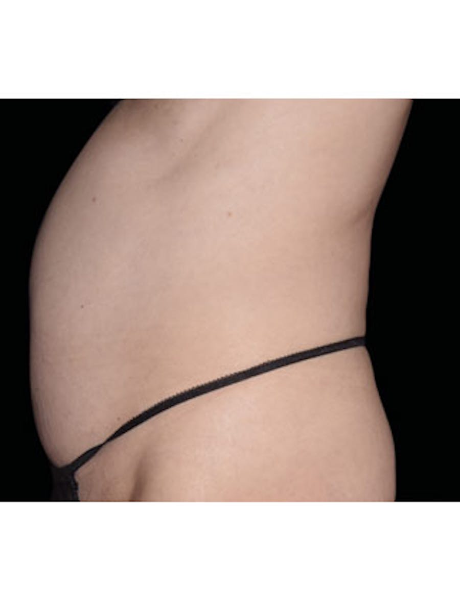 Emsculpt Neo Before & After Gallery - Patient 25139433 - Image 1
