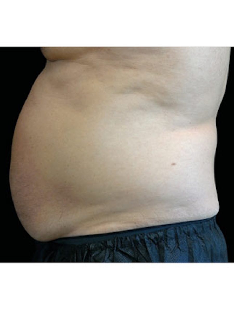 Emsculpt Neo Before & After Gallery - Patient 25139458 - Image 1