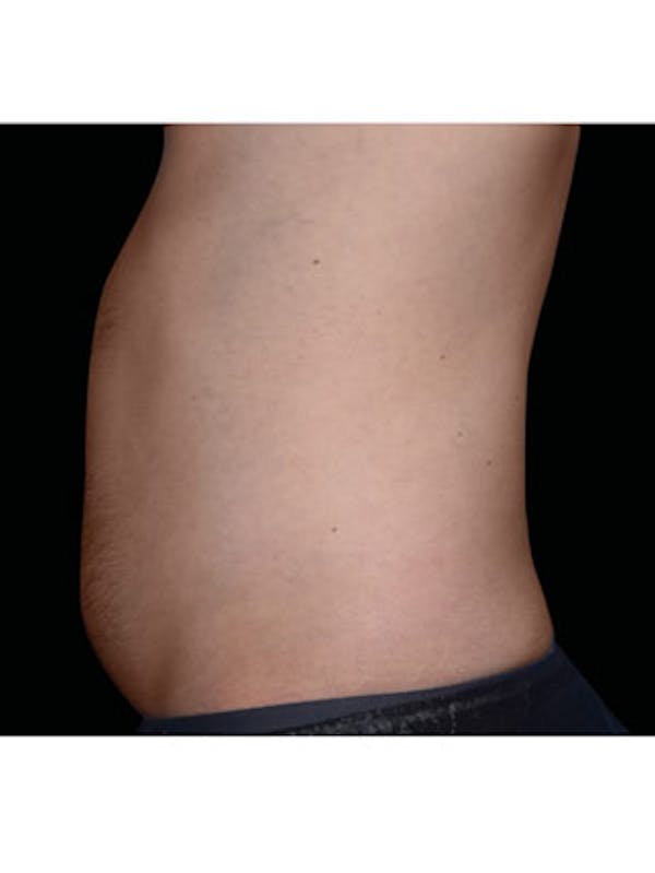 Emsculpt Neo Before & After Gallery - Patient 25139464 - Image 1