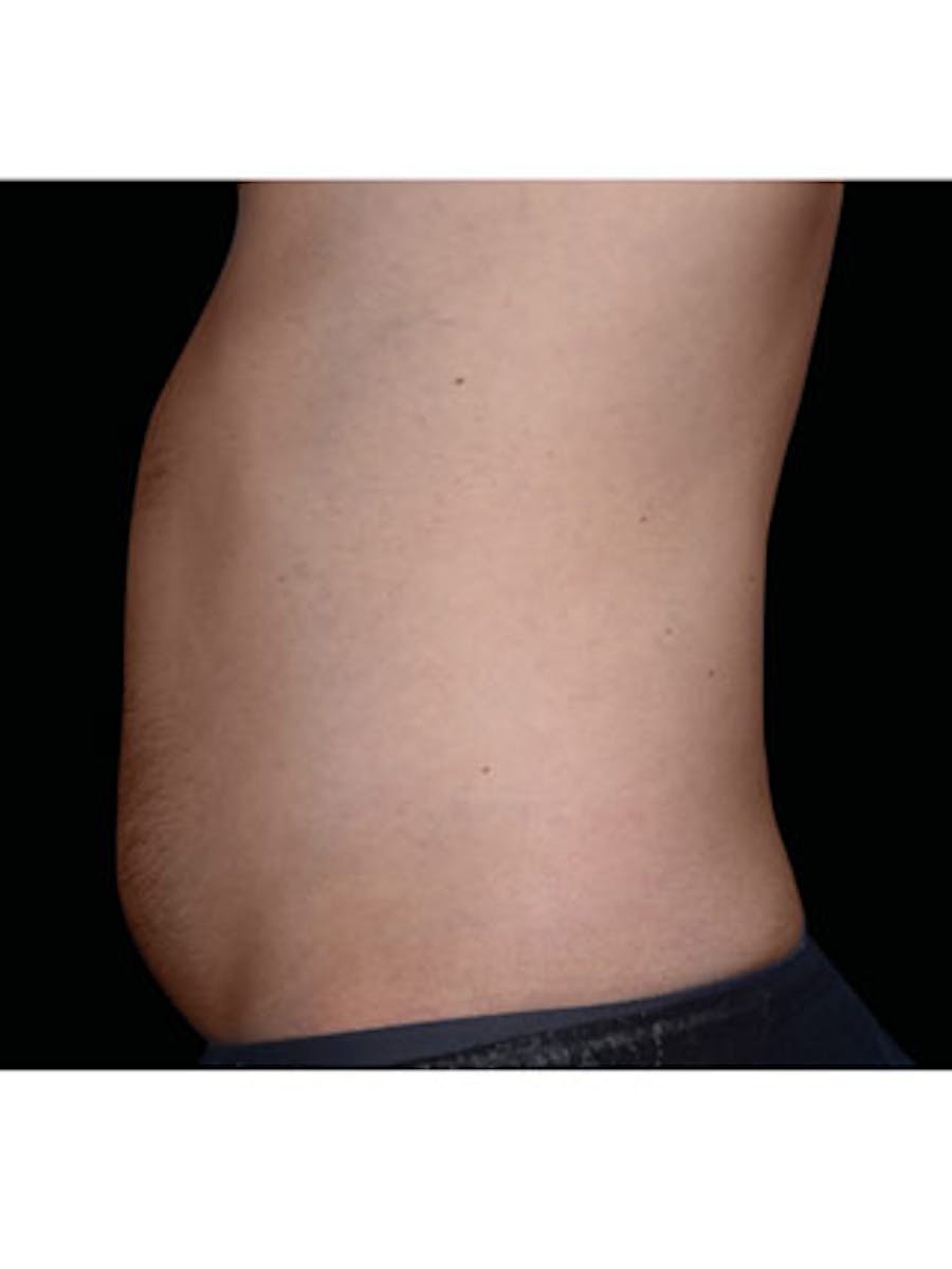 Emsculpt Neo Before & After Gallery - Patient 25139464 - Image 1