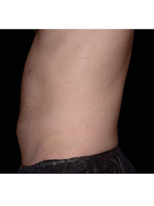 Emsculpt Neo Before & After Gallery - Patient 25139464 - Image 2