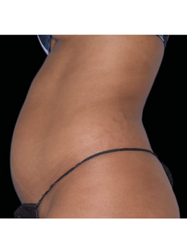 Emsculpt Neo Before & After Gallery - Patient 25139465 - Image 1