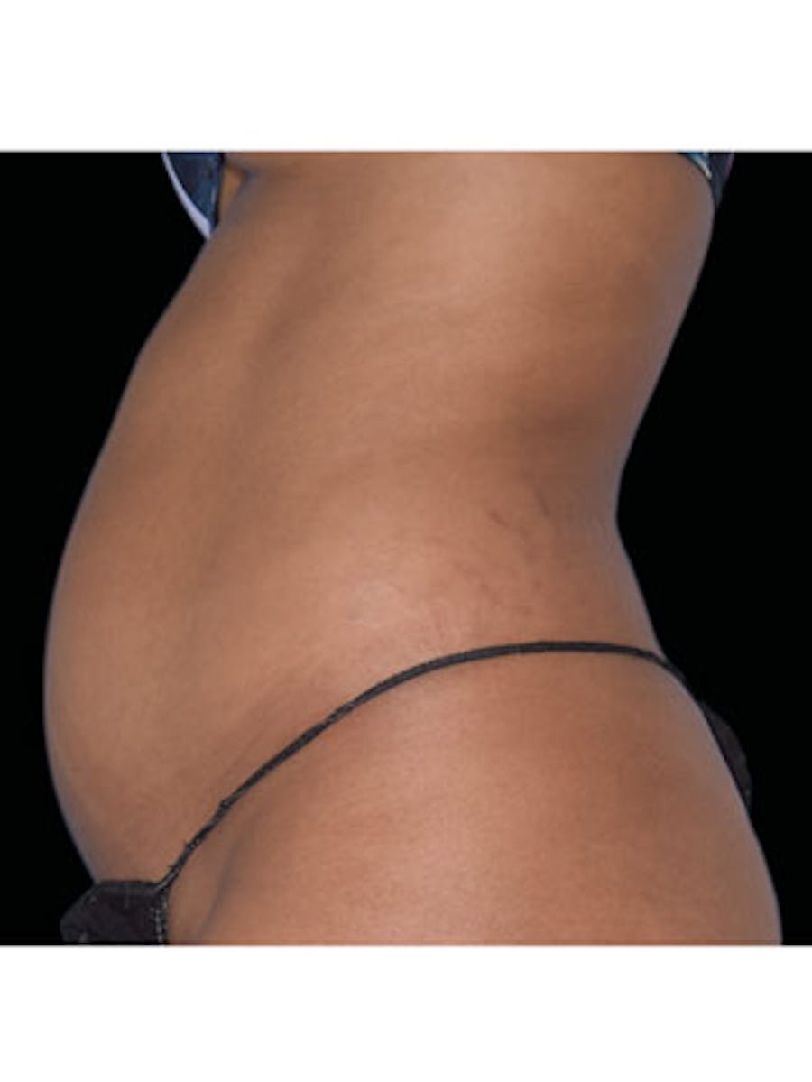 Emsculpt Neo Before & After Gallery - Patient 25139465 - Image 1