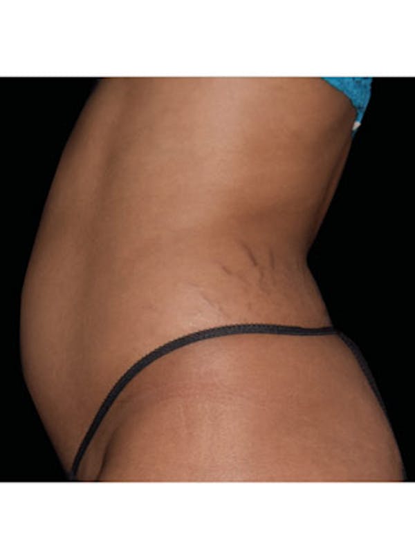 Emsculpt Neo Before & After Gallery - Patient 25139465 - Image 2